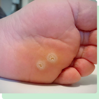 Ingrown Wart Removal Woodbridge profile picture